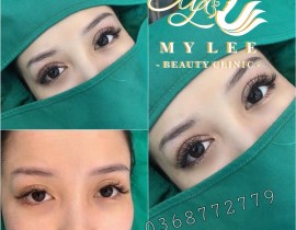 Nhấn và cắt mí