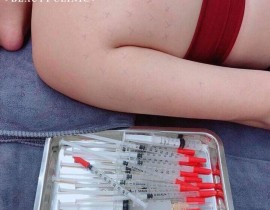 Tiêm filler Mỡ