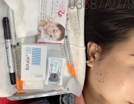 Tiem-botox-thon-gon-ham-vline-Nha-Trang-3.jpg